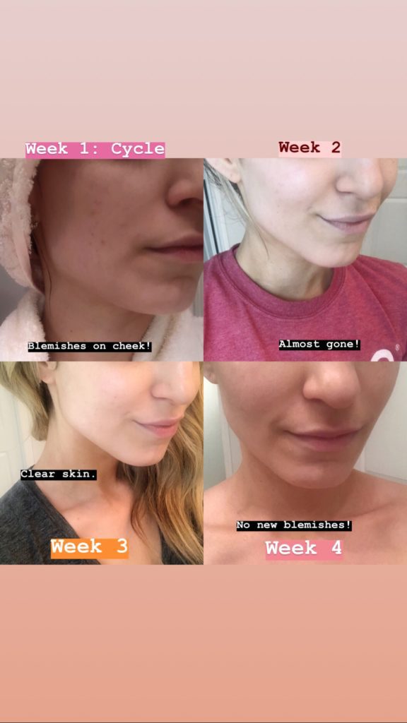 Weekly Results of Tula Acne Gel